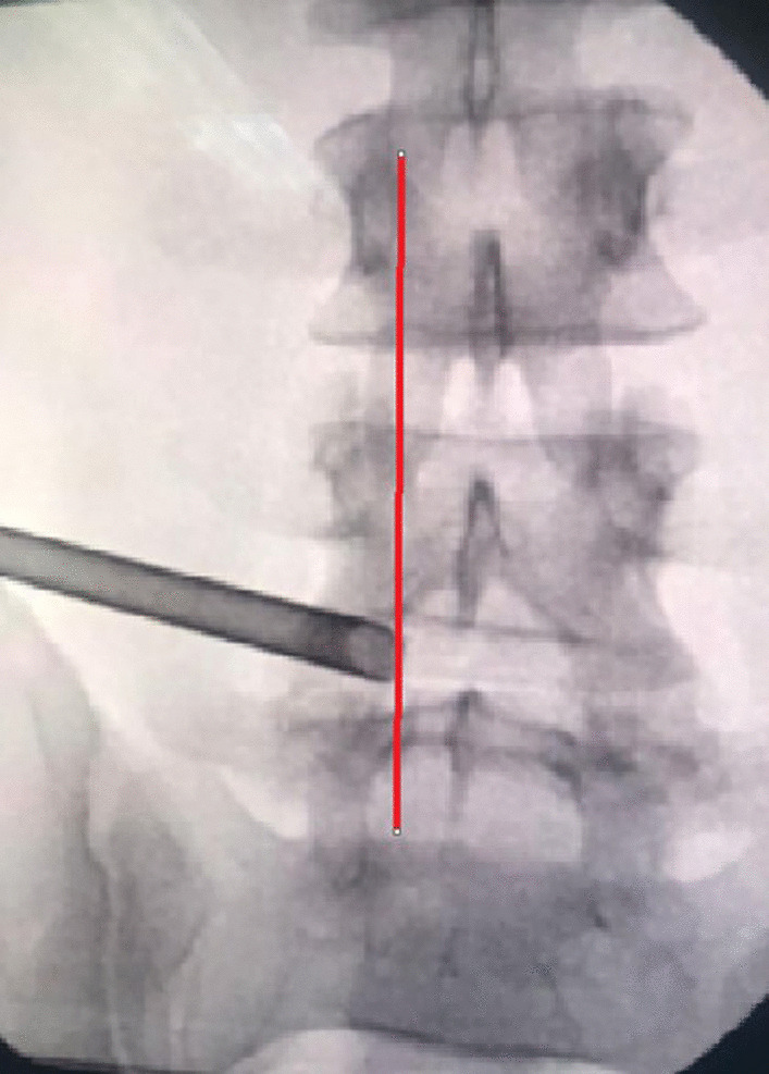 Percutaneous full-endoscopic transforaminal discectomy versus open microdiscectomy in the treatment of lumbar disc herniation: randomized controlled trial