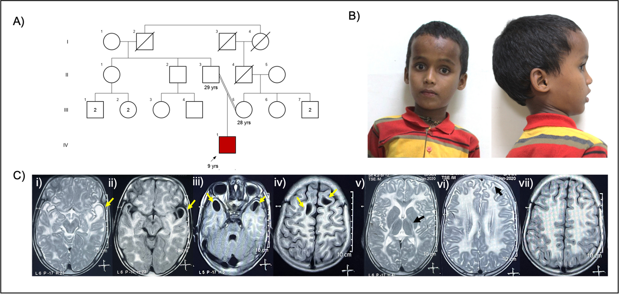 Intragenic homozygous duplication in HEPACAM is associated with megalencephalic leukoencephalopathy with subcortical cysts type 2A