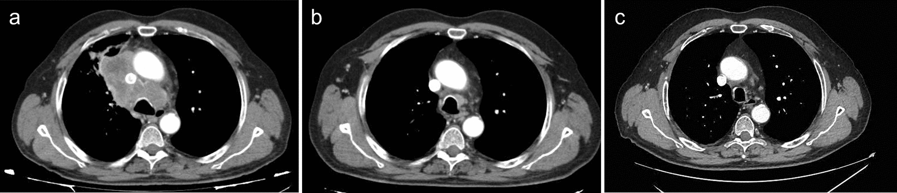 Long-Term Survival and Stable Disease in a Patient with Extensive-Stage Small-Cell Lung Cancer after Treatment with Carboplatin, Etoposide and Atezolizumab