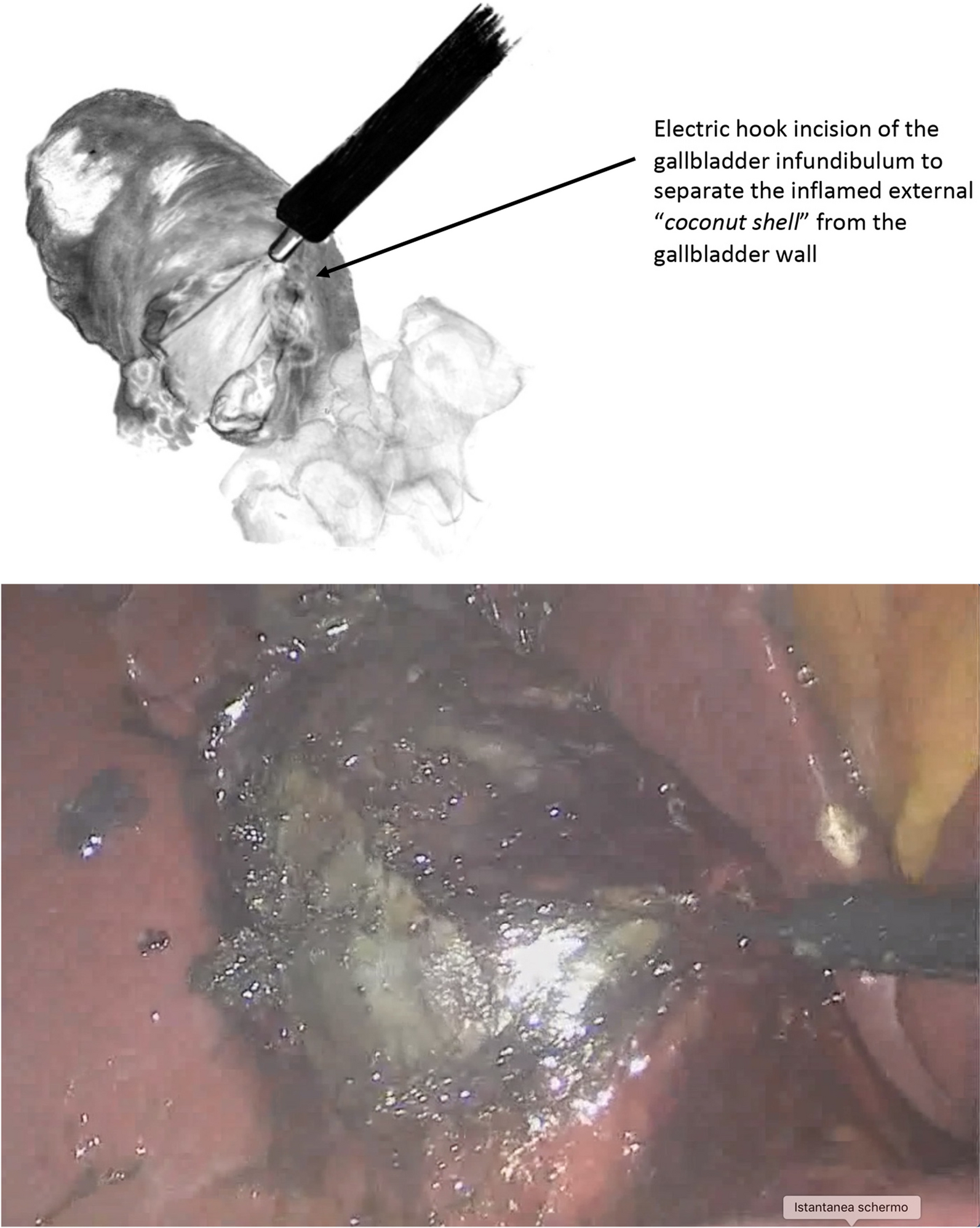 Acute cholecystitis: how to avoid subtotal cholecystectomy—preliminary results