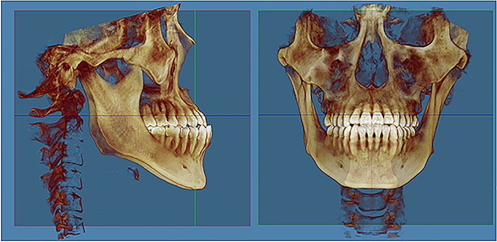 Evaluation of three-dimensional reconstructed palatal morphology in skeletal class III subjects with different vertical patterns using cone beam computed tomography