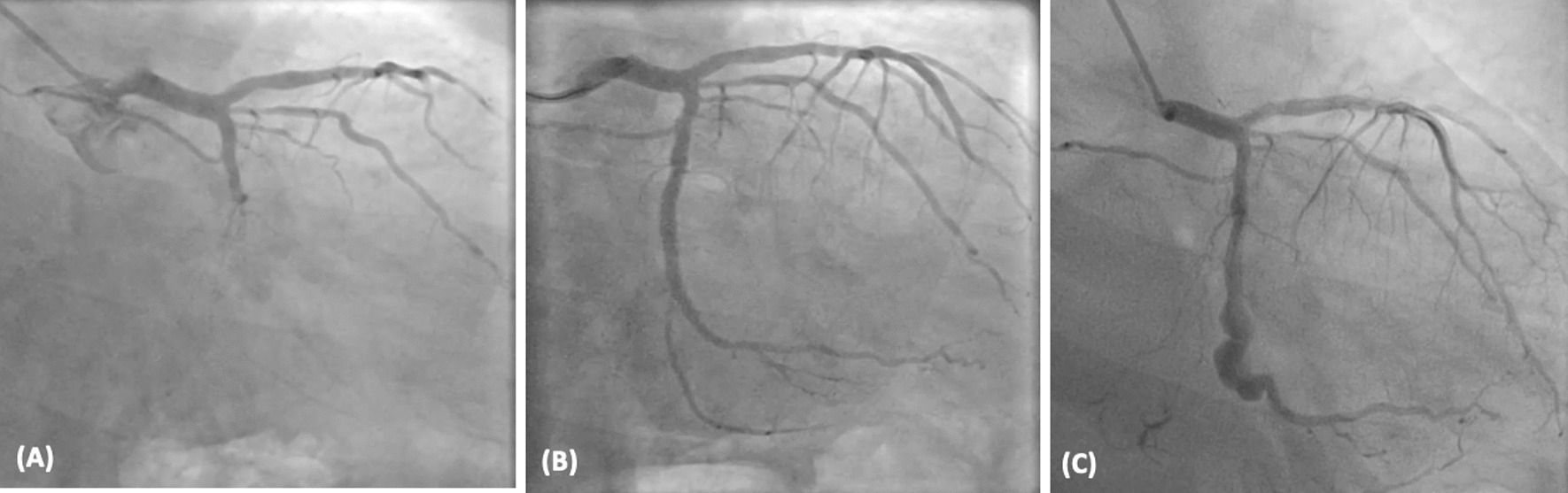 A case report of left circumflex stent infection and mycotic aneurysm: a rare but life-threatening complication of percutaneous coronary intervention