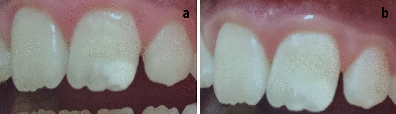 Management of permanent incisors affected by Molar-Incisor-Hypomineralisation (MIH) using resin infiltration: a pilot study