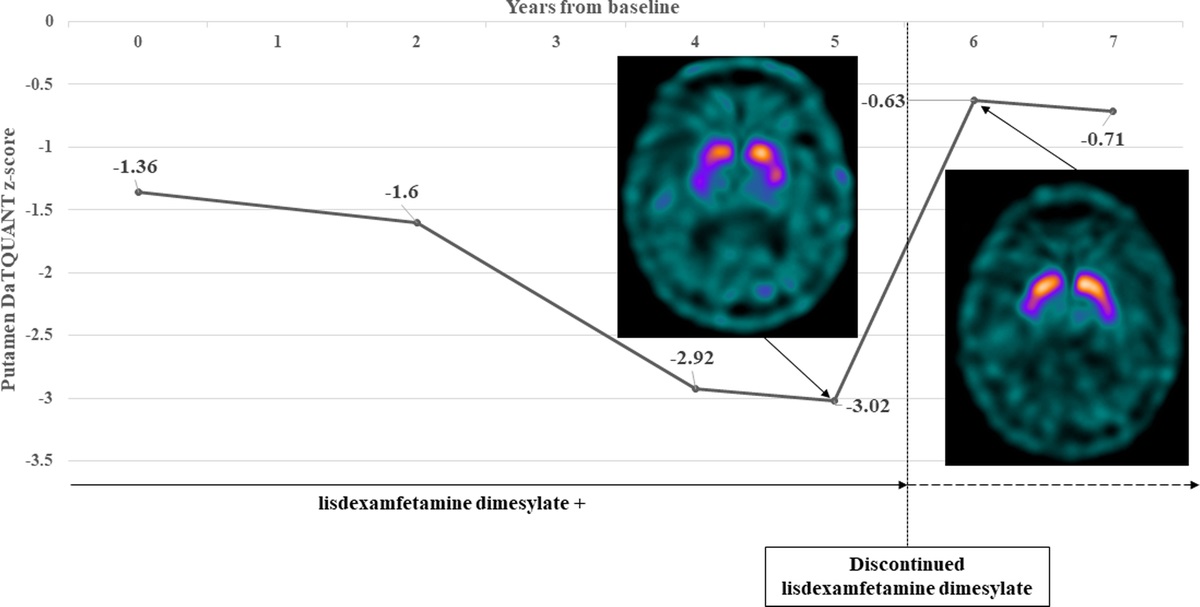 Marked Decreased Tracer Binding in 123I-FP-CIT SPECT Scans From Lisdexafetamine Dismesylate Interaction: A Case Report