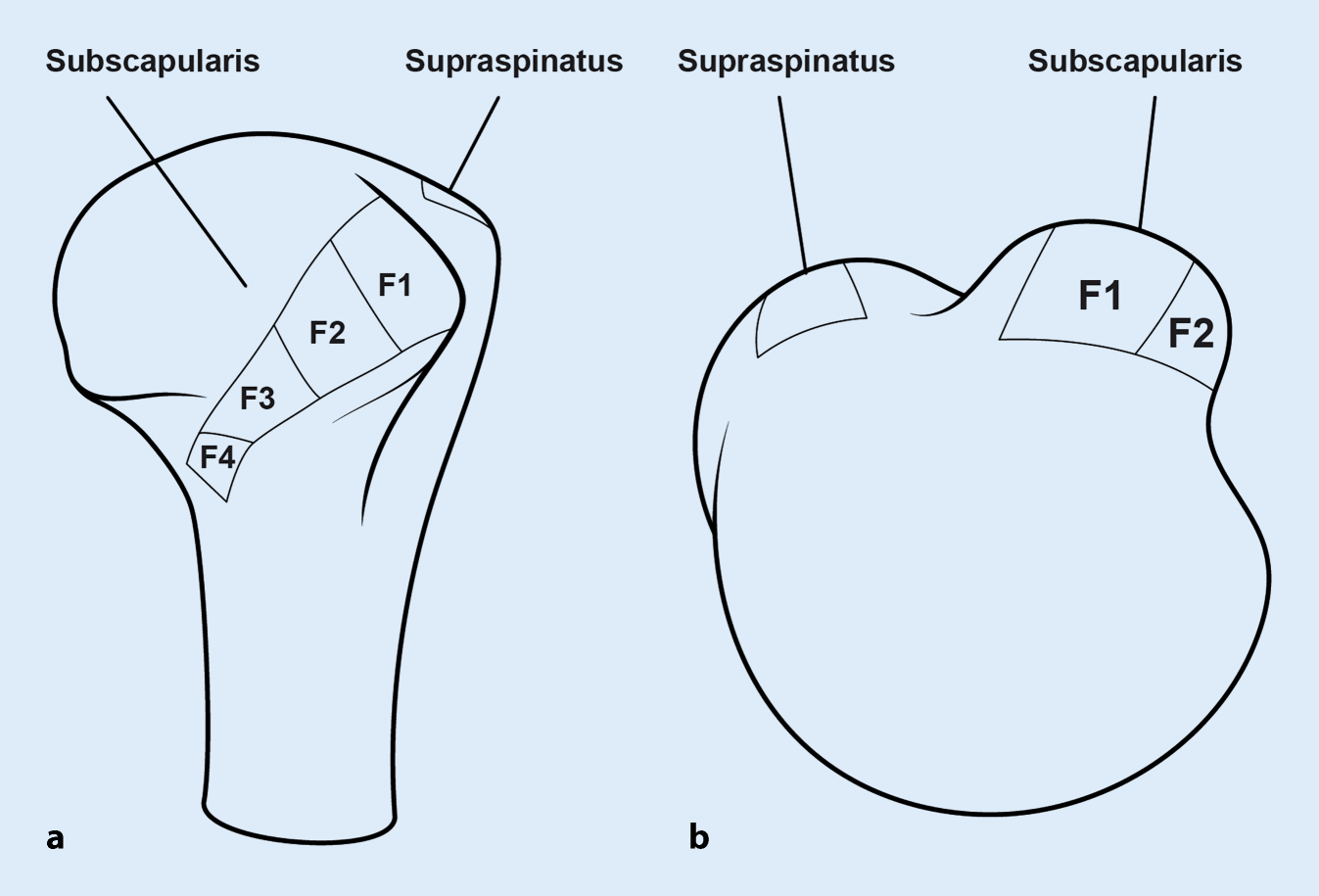 Prospektive randomisierte klinische Studie zum Vergleich von arthroskopischer Rekonstruktion und Débridement bei partiellen Subskapularissehnenverletzungen