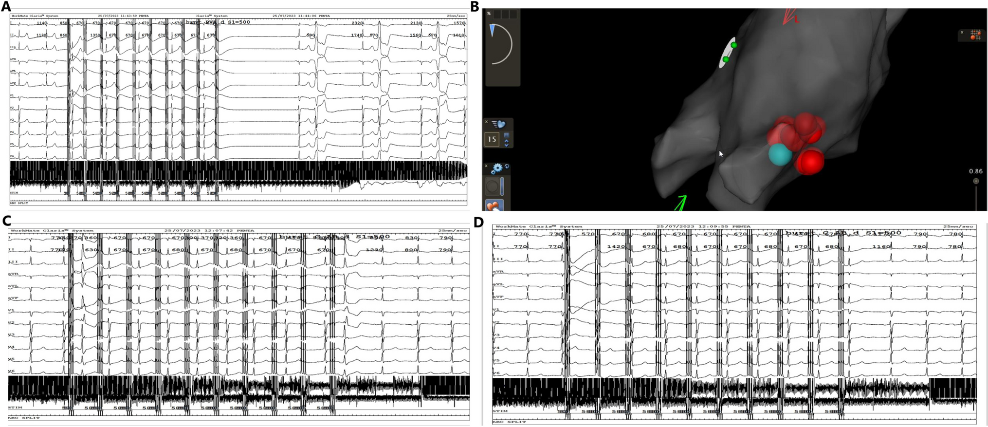 Focal pulsed field ablation for guiding and assessing the acute effect of cardioneuroablation