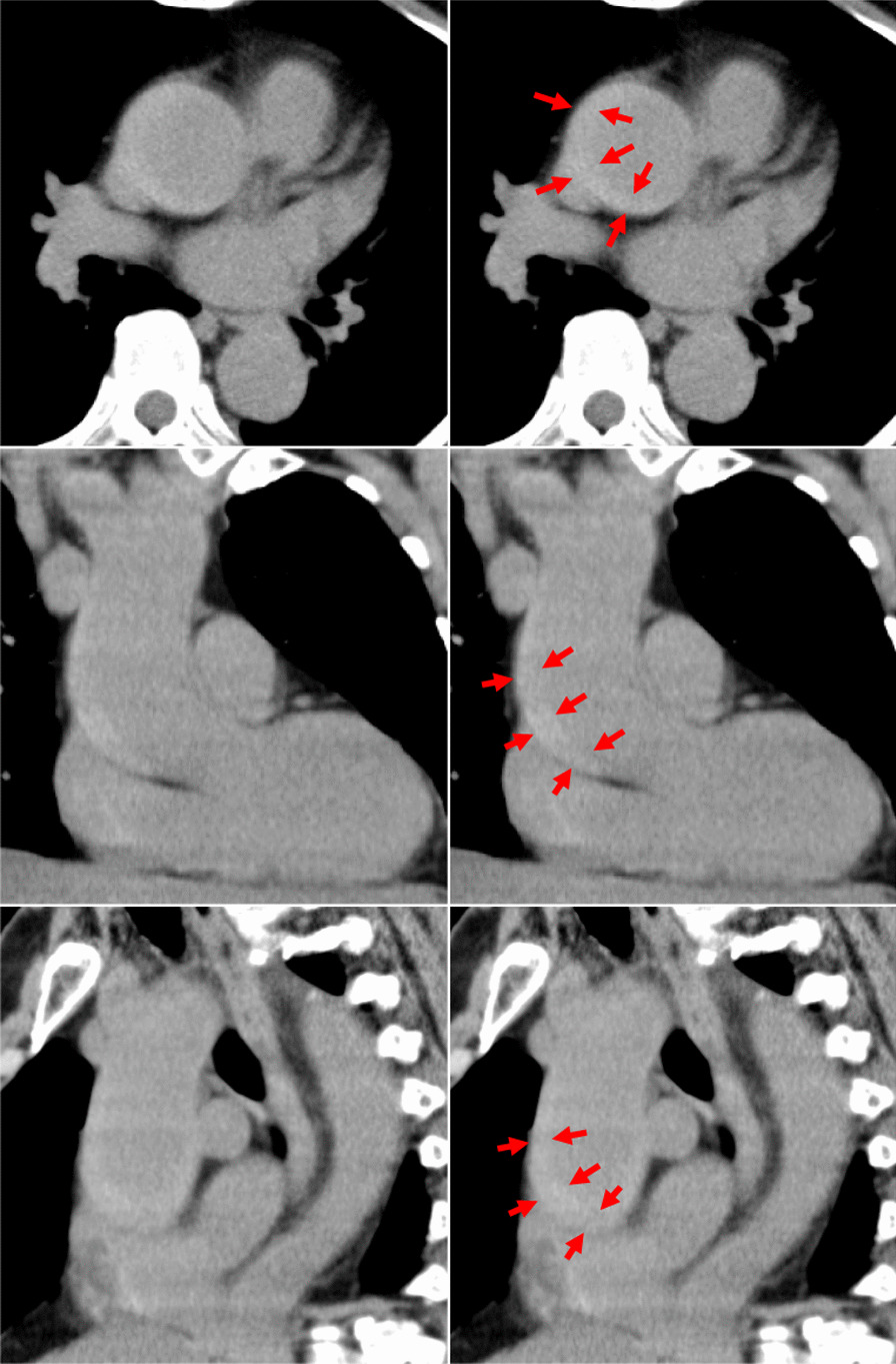 Three cases of diagnostic delay of type A acute aortic dissection