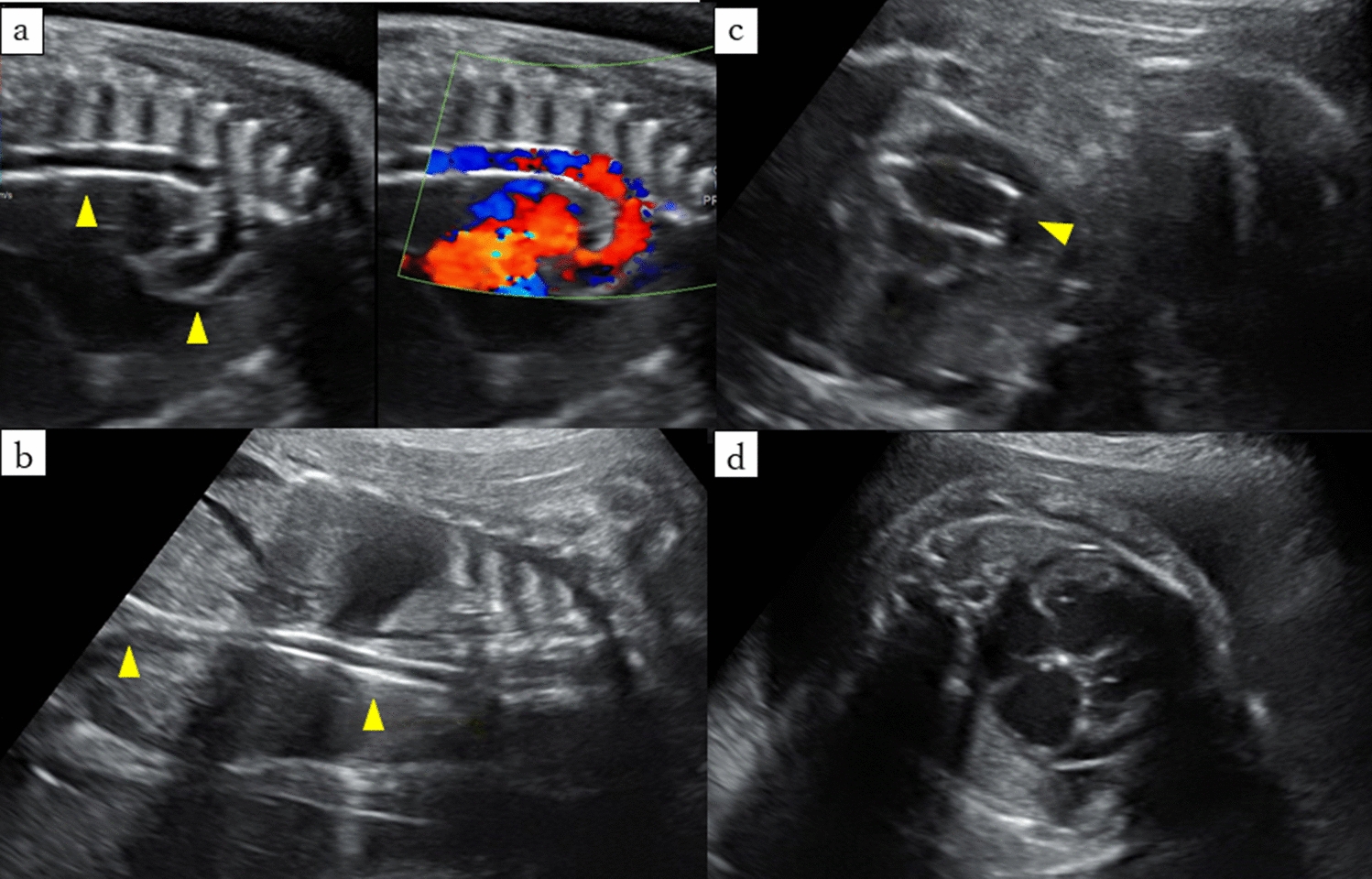 A case of fetal hydrops caused by generalized arterial calcification of infancy