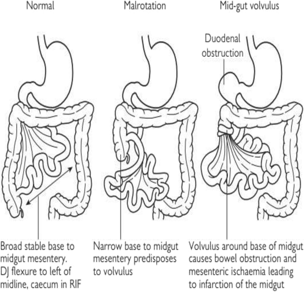 The performance of ultrasound and upper gastrointestinal study in diagnosing malrotation in children, with or without volvulus