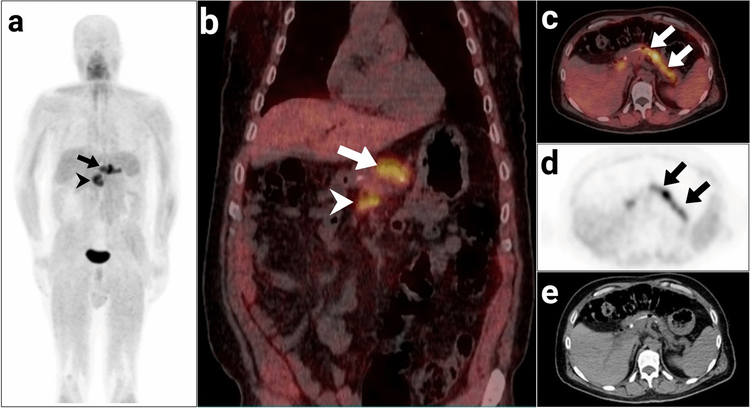 Stent-Induced [68Ga]Ga-FAPI Diffuse Expression in a Patient with Pancreatic Cancer: Navigating Non-oncologic Challenges