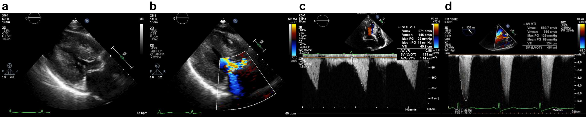 A case of left ventricular outflow tract obstruction detected after transcatheter aortic valve implantation