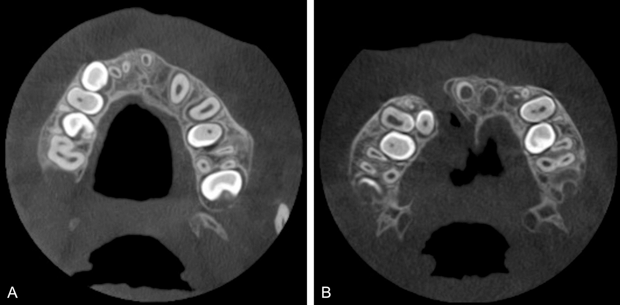 Quantitative assessment of cleft volume and evaluation of cleft’s impact on adjacent anatomical structures using CBCT imaging