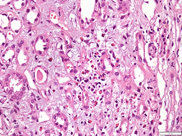 A case of acute interstitial nephritis superimposed on rhabdomyolysis in a refugee patient