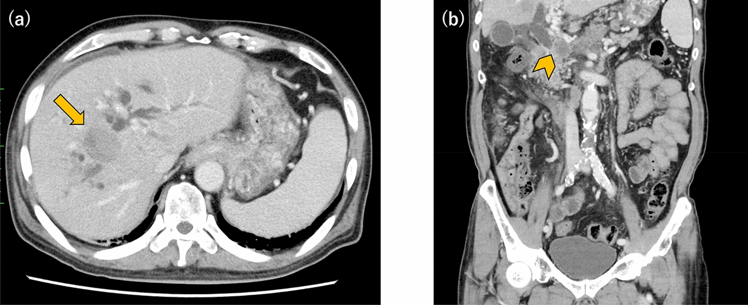 Rapid tumor progression complicated with liver abscess in a patient with gastric cancer receiving nivolumab therapy
