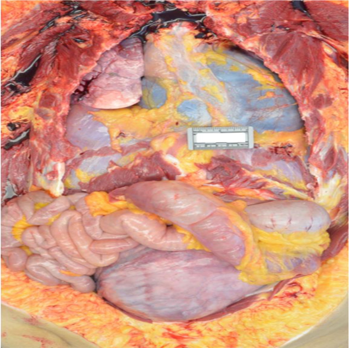 Ruptured Aortic Dissection in an Unrecognized, Late-Term Intrauterine Pregnancy