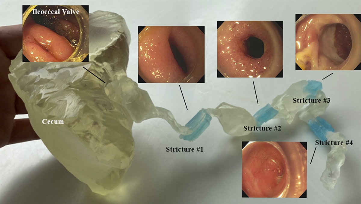 Three-Dimensional Modeling to Guide Interventional Endoscopy in Fibrostenotic Crohn's Disease
