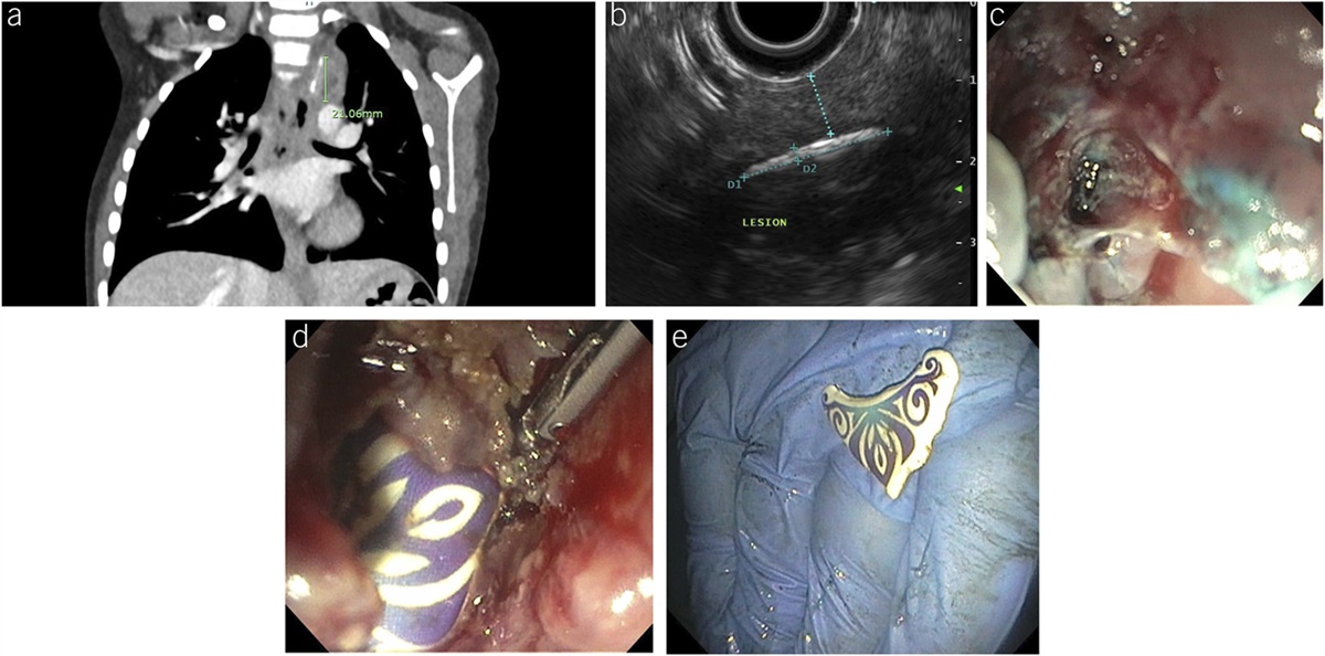 Endoscopic Ultrasound-Guided Removal of an Unusual Paraesophageal Foreign Body Through the Esophageal Wall