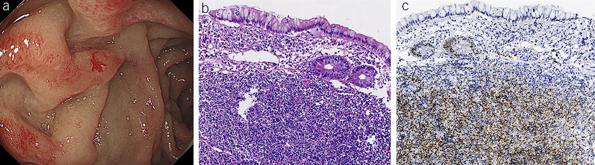 Mantle Cell Lymphoma Presenting as Erosive Duodenitis