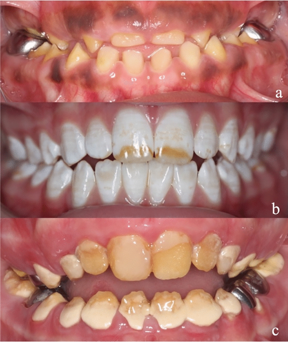 Establishment of a clinical network for children with amelogenesis imperfecta and dentinogenesis imperfecta in the UK: 4-year experience
