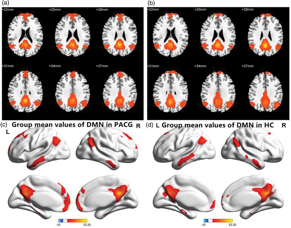 Altered functional connectivity between the default mode network in primary angle-closure glaucoma patients