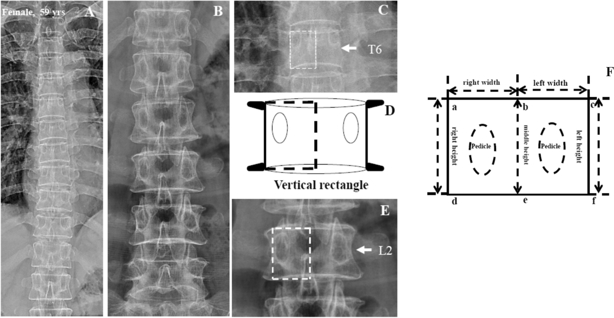 Vertebral fracture severity assessment on anteroposterior radiographs with a new semi-quantitative technique