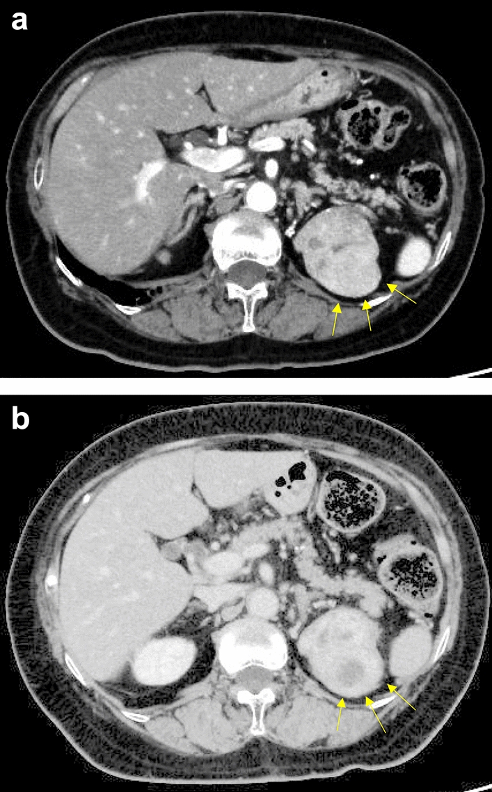 Intratumoral metastasis of sigmoid colon cancer to chromophobe renal cell carcinoma: a case report