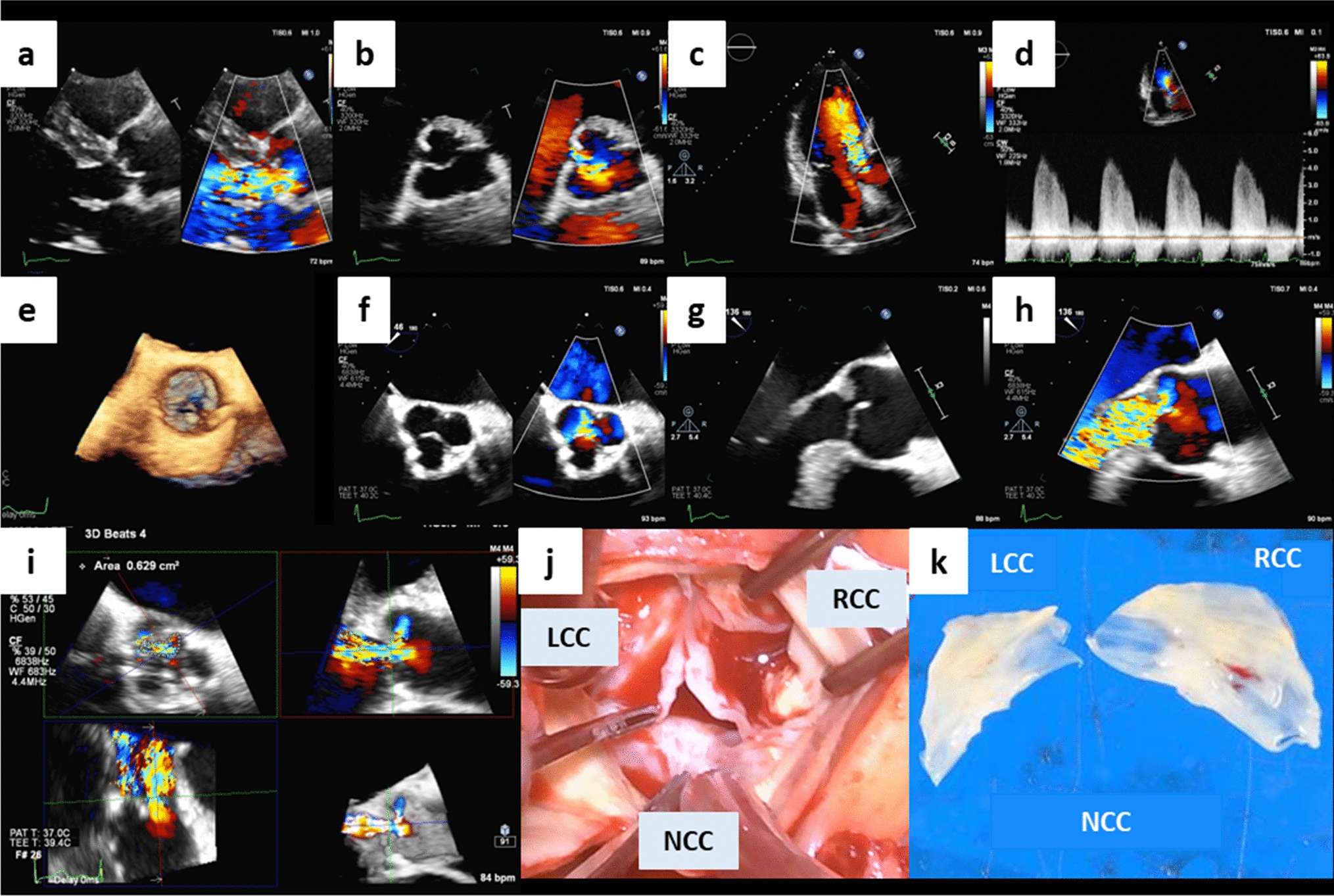 Extreme shortening of non-coronary cusp of the aortic valve detected by transesophageal echocardiography: a case report