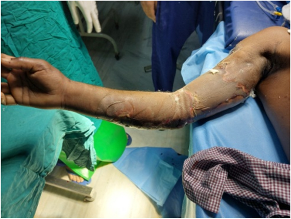 A Rare Case of Nicolau’s Syndrome (Embolia Cutis Medicamentosa) Following Intramuscular Diclofenac Sodium Injection in a Young Adult