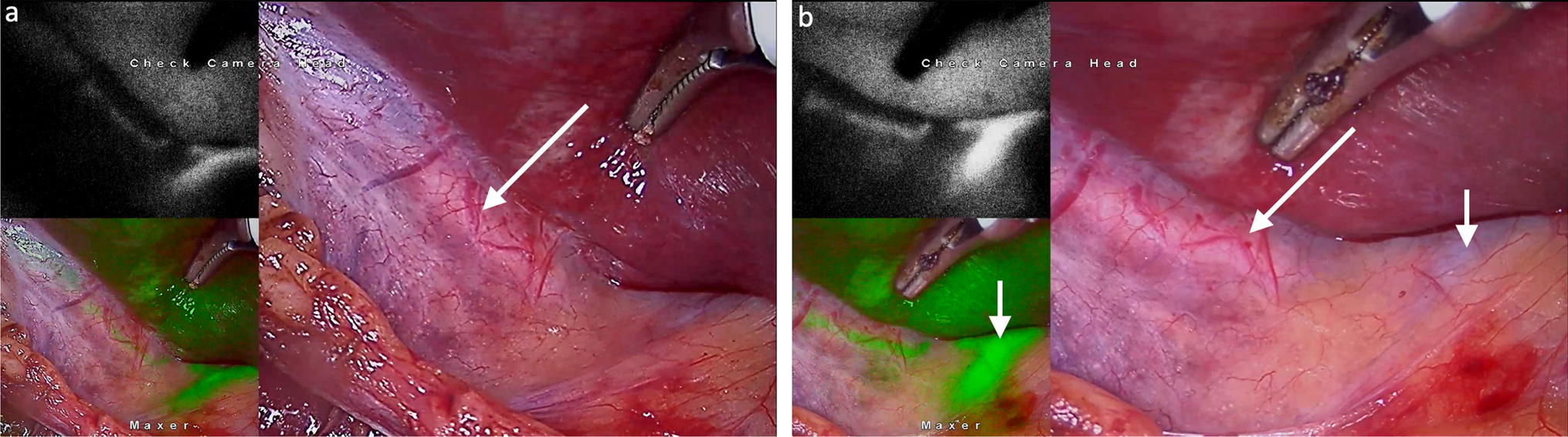 Routine Use of Indocyanine Green Fluorescence Cholangiography in Cholecystectomy at Marginal Cost and High Dividends: Subvesical Duct Identified