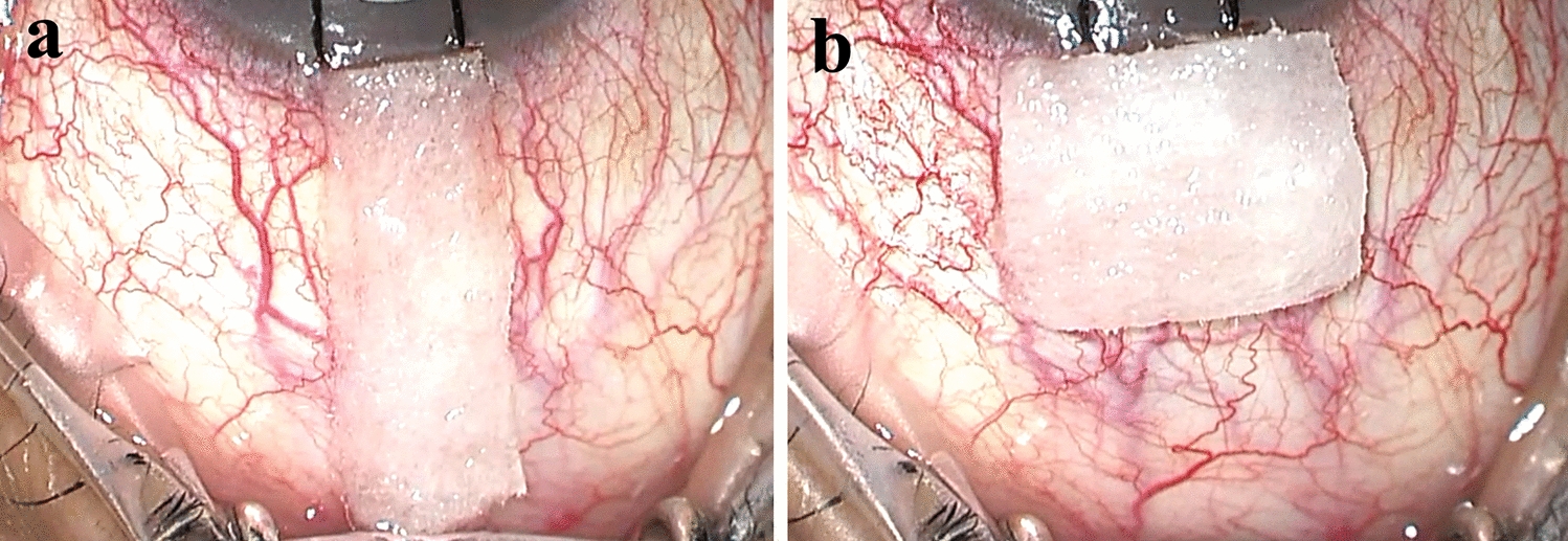 Two-year outcomes of anterior versus posterior scleral application of mitomycin C-soaked sponge in trabeculectomy