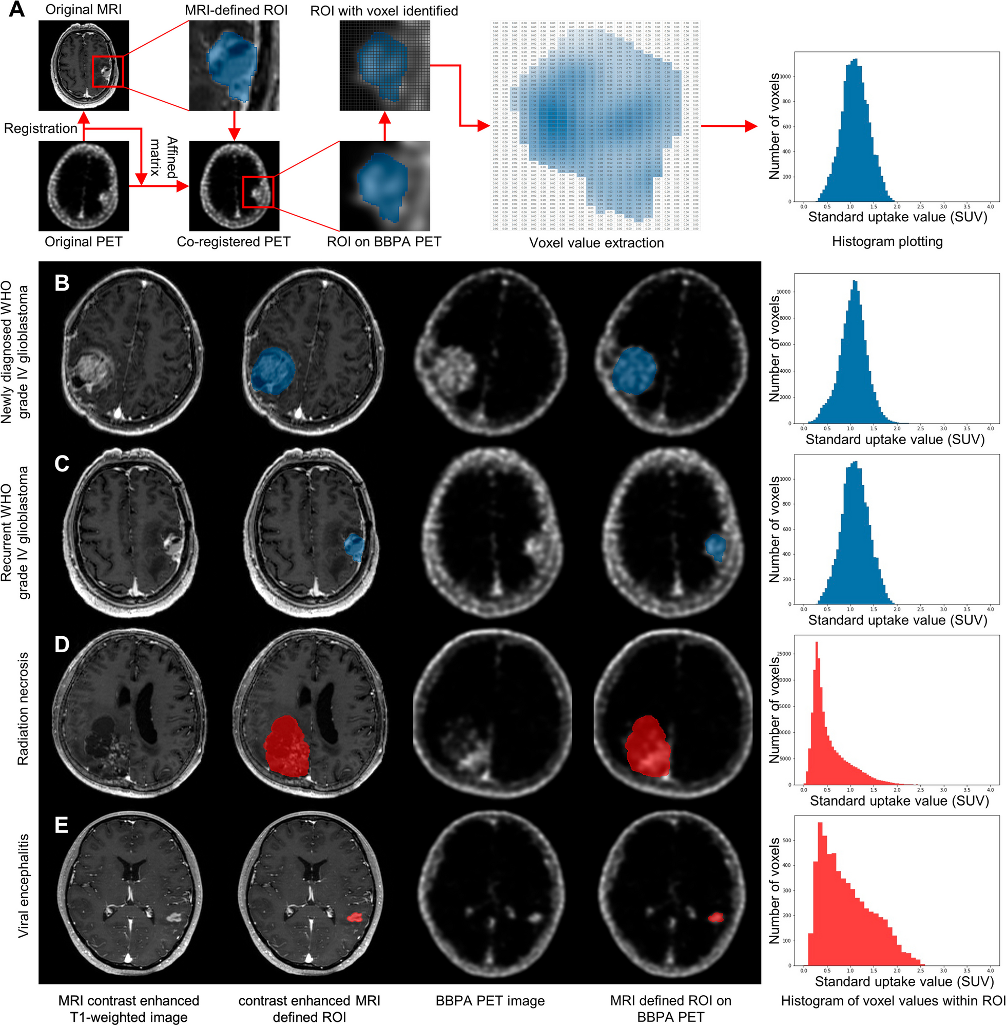A histogram of [18F]BBPA PET imaging differentiates non-neoplastic lesions from malignant brain tumors