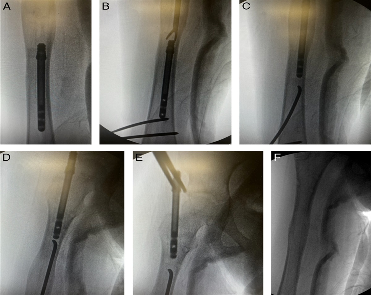 A Novel Technique for Removal of a Dissociated Femoral Intramedullary Magnetic Lengthening Nail