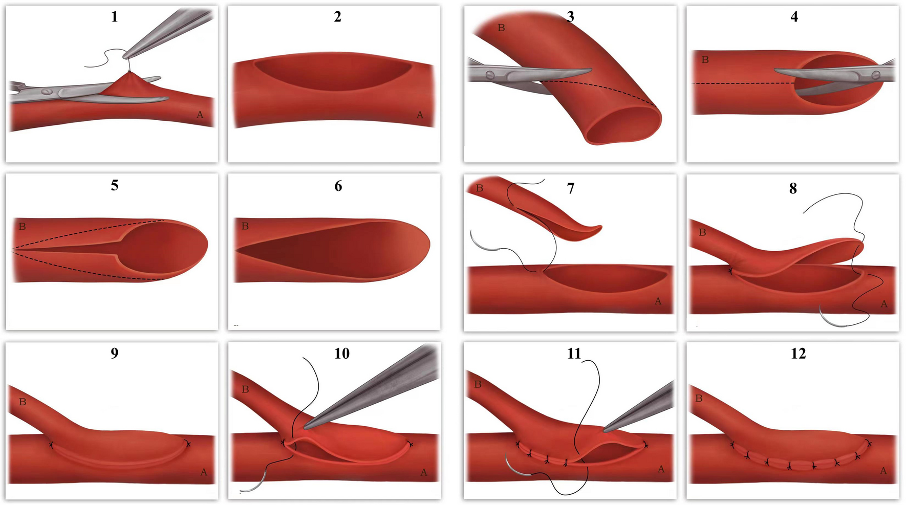 The sucker-like end-to-side arterial anastomosis for free flap in extremities reconstruction: a retrospective study of 78 cases