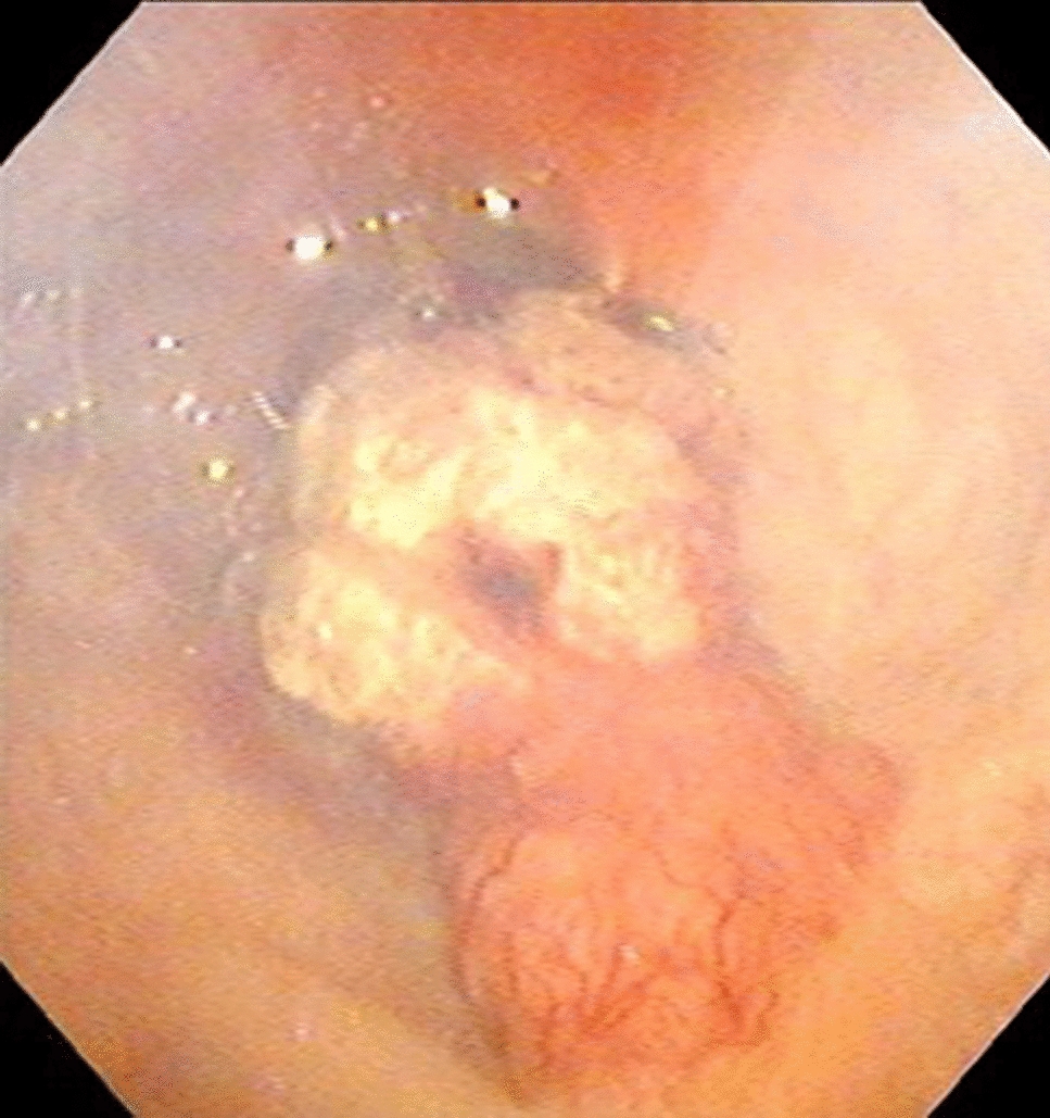 Primary signet-ring cell carcinoma of the bladder treated with laparoscopic radical cystectomy: a case report