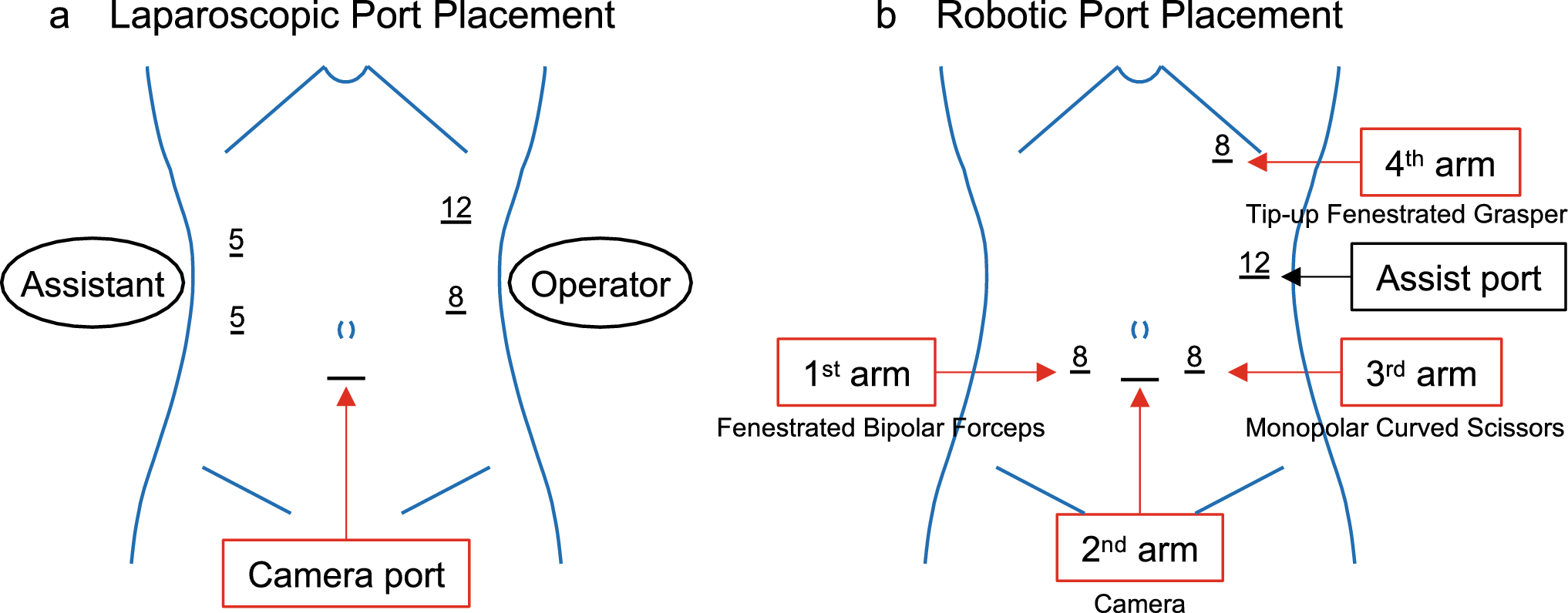 Utility of articulating instruments as an alternative to robotic devices in laparoscopic right hemicolectomy