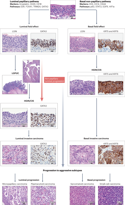 Molecular profile of bladder cancer progression to clinically aggressive subtypes