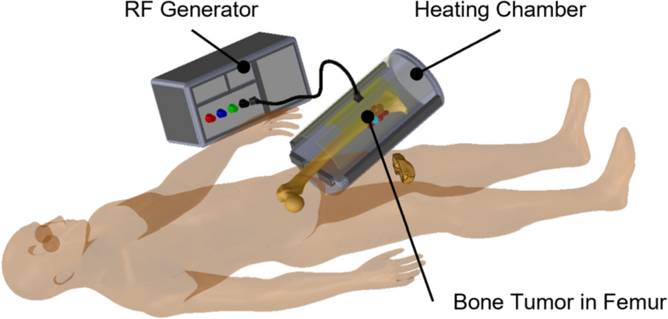 Optimal design of bone tumor ablation device based on radio frequency heating using Taguchi method