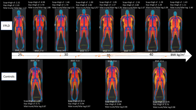 Clinical and imaging features of women with polygenic partial lipodystrophy: a case series