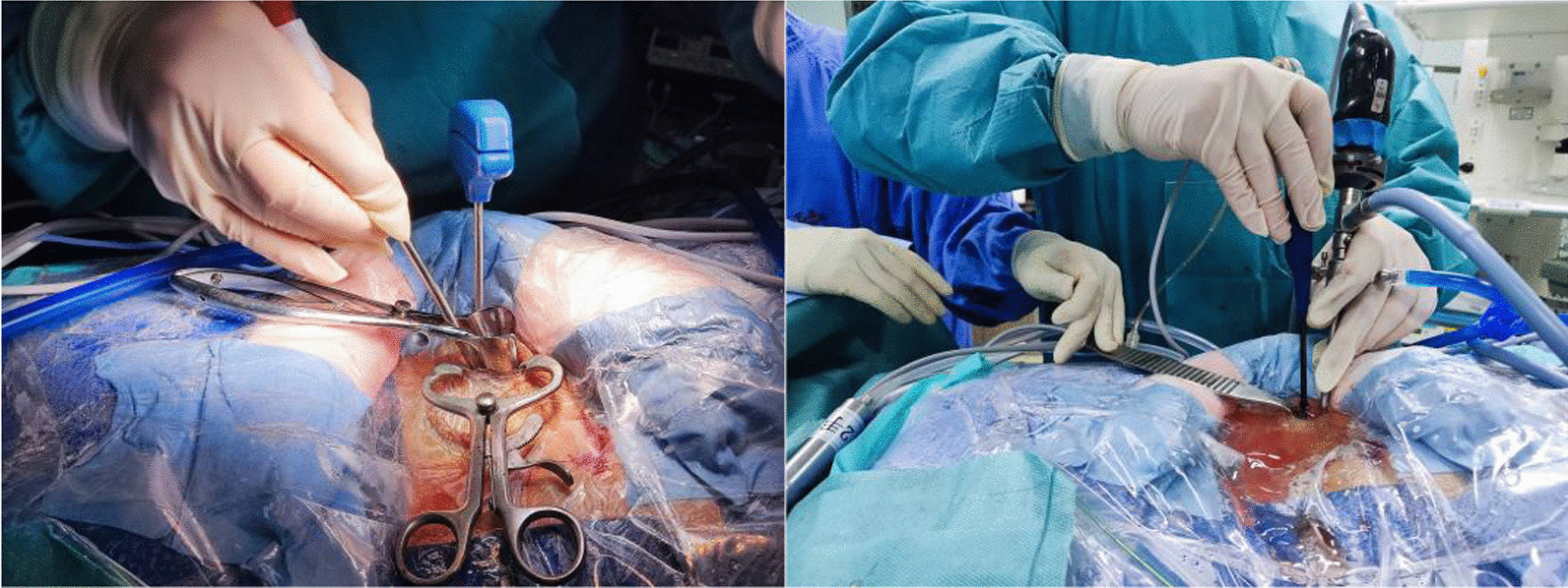 Comparison of one-hole split endoscopic discectomy and microendoscopic discectomy in the treatment of lumbar disk herniation: a one-year retrospective cohort study