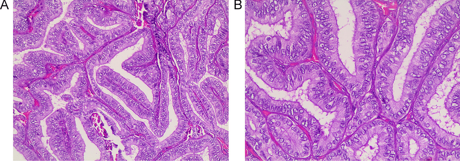 Focal Tall Cell Change in Papillary Thyroid Carcinoma: Lessons Learned from Practices Adopting Rigid Criteria (Height to Width Ratio of 3)