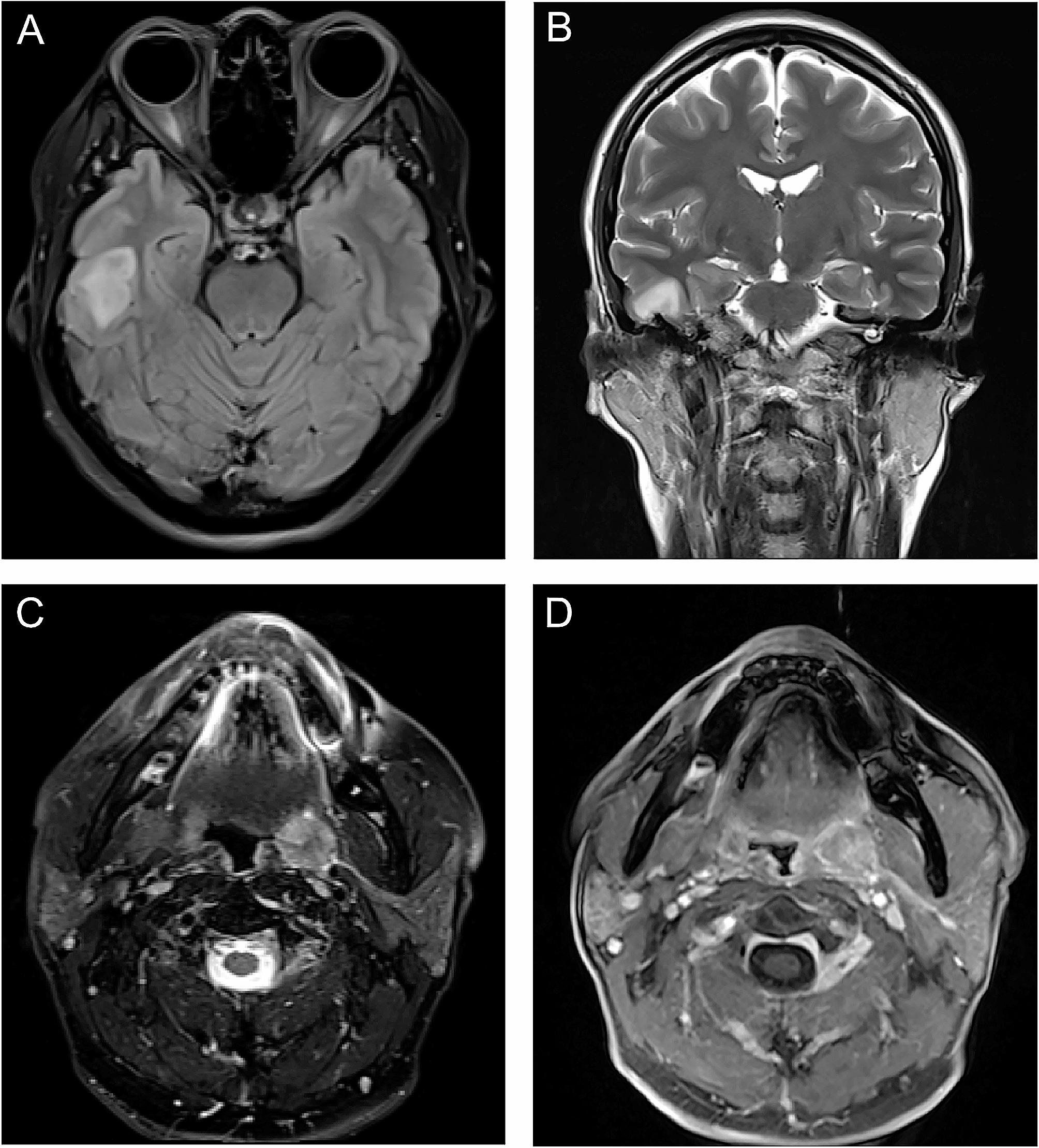 Applying ONCO-RADS to whole-body MRI cancer screening in a retrospective cohort of asymptomatic individuals