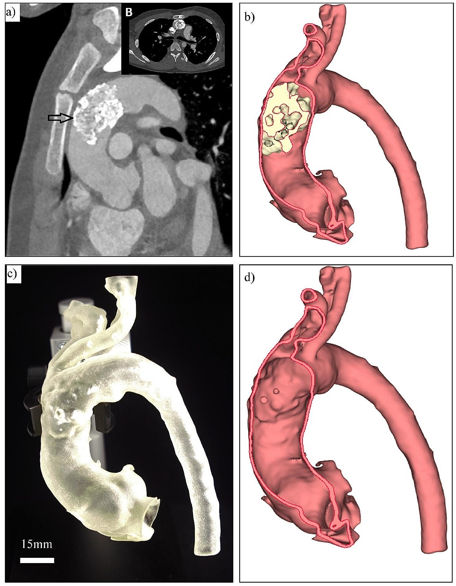 Coral reef aorta: a rare form of obstruction of the ascending aorta in adolescent with aortopathy- case report