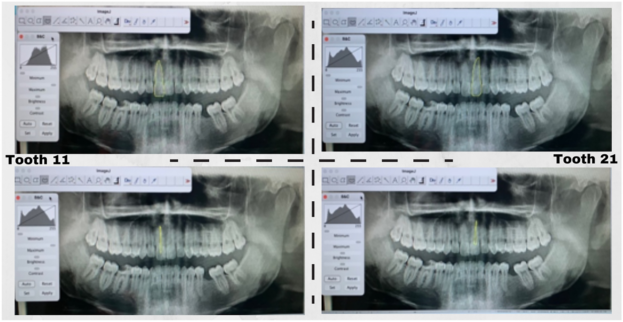 Study of secondary dentine deposition in central incisors as an age estimation method for adults