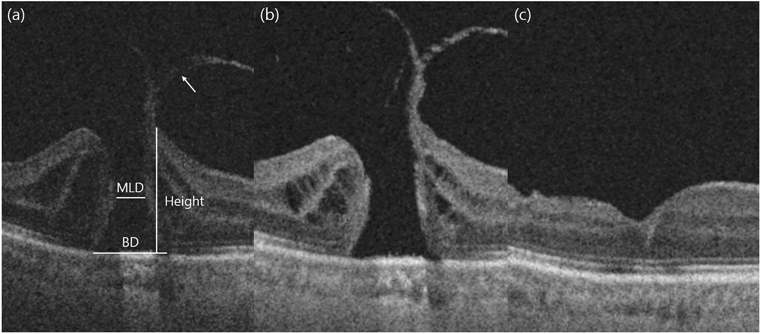 Analysis of the progression rate of idiopathic macular holes and the optimal cut-off for baseline minimum linear diameter and base diameter