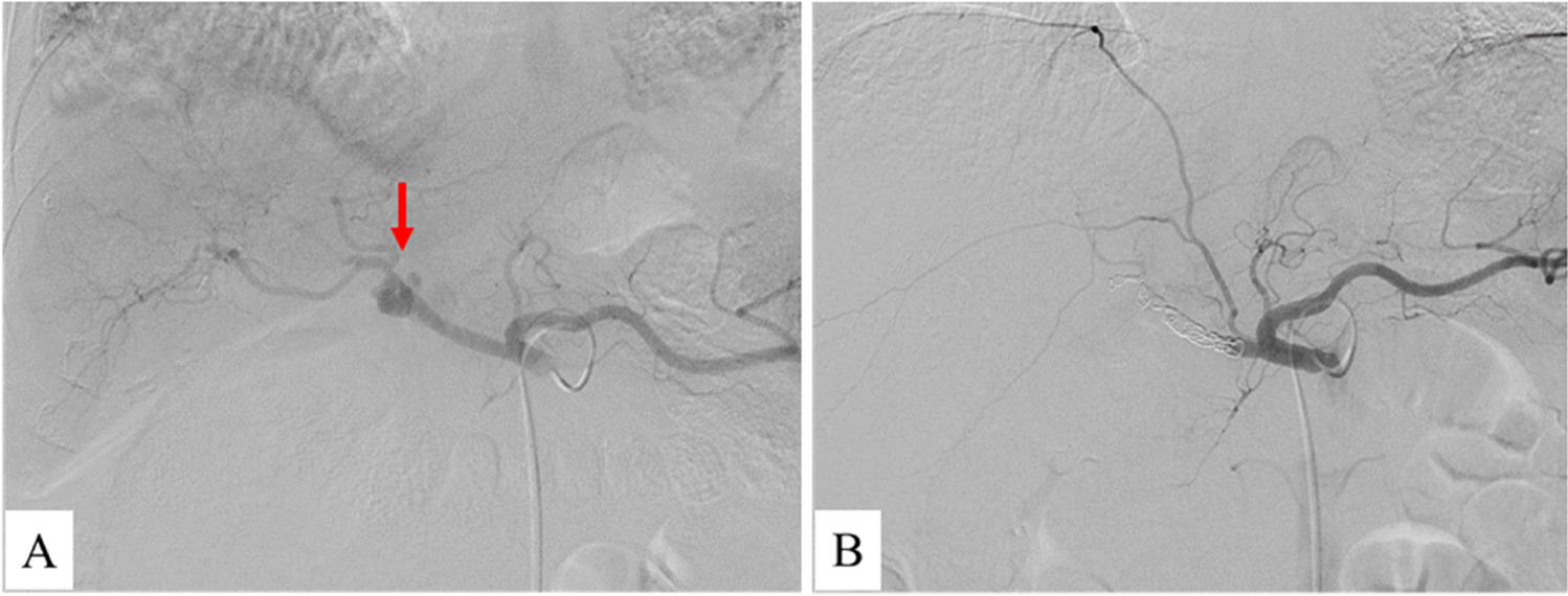 Transcatheter arterial embolization with N-butyl cyanoacrylate for postoperative hemorrhage treatment following pancreatoduodenectomy