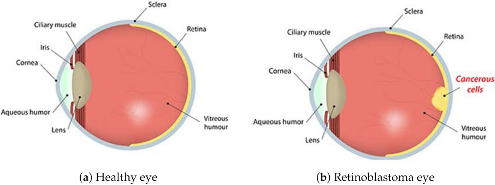 Nanotechnology-based strategies overcoming the challenges of retinoblastoma: a comprehensive overview and future perspectives
