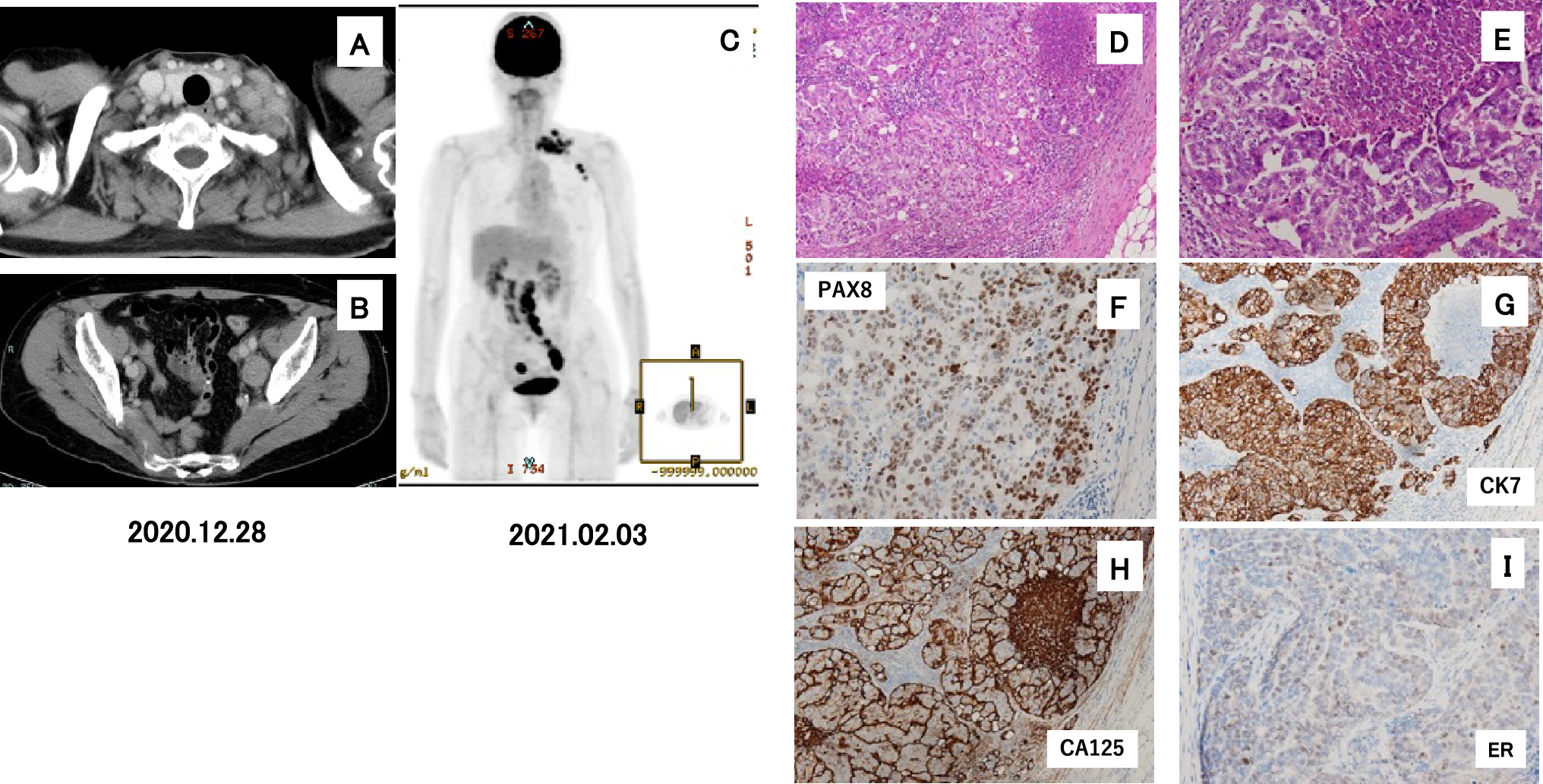 A case of hereditary breast and ovarian cancer syndrome of initially presented as cancer of unknown primary with lymph node metastases unveiled by genetic analysis