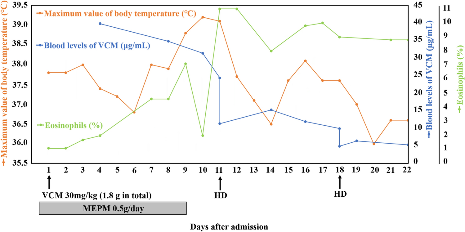 Hemodialysis treatment of vancomycin-induced drug reaction with eosinophilia and systemic symptoms/drug-induced hypersensitivity syndrome in a patient undergoing peritoneal dialysis