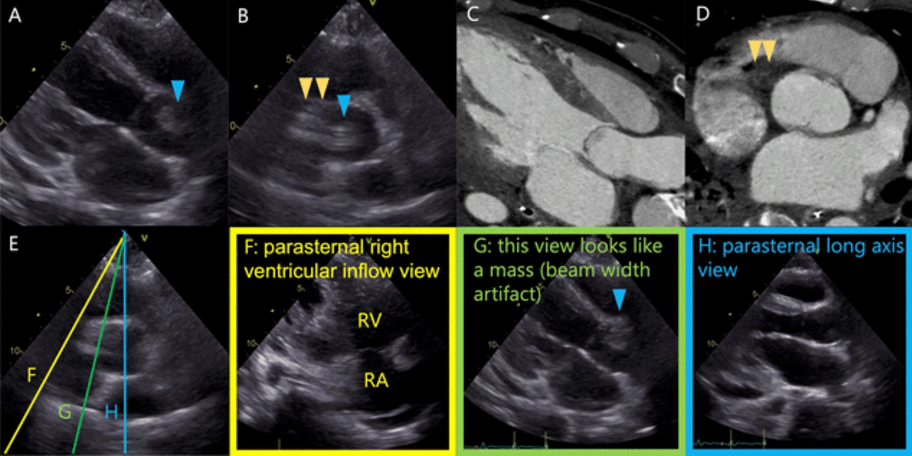 Mass-like lesion in the ascending aorta by side lobe and beam width artifacts
