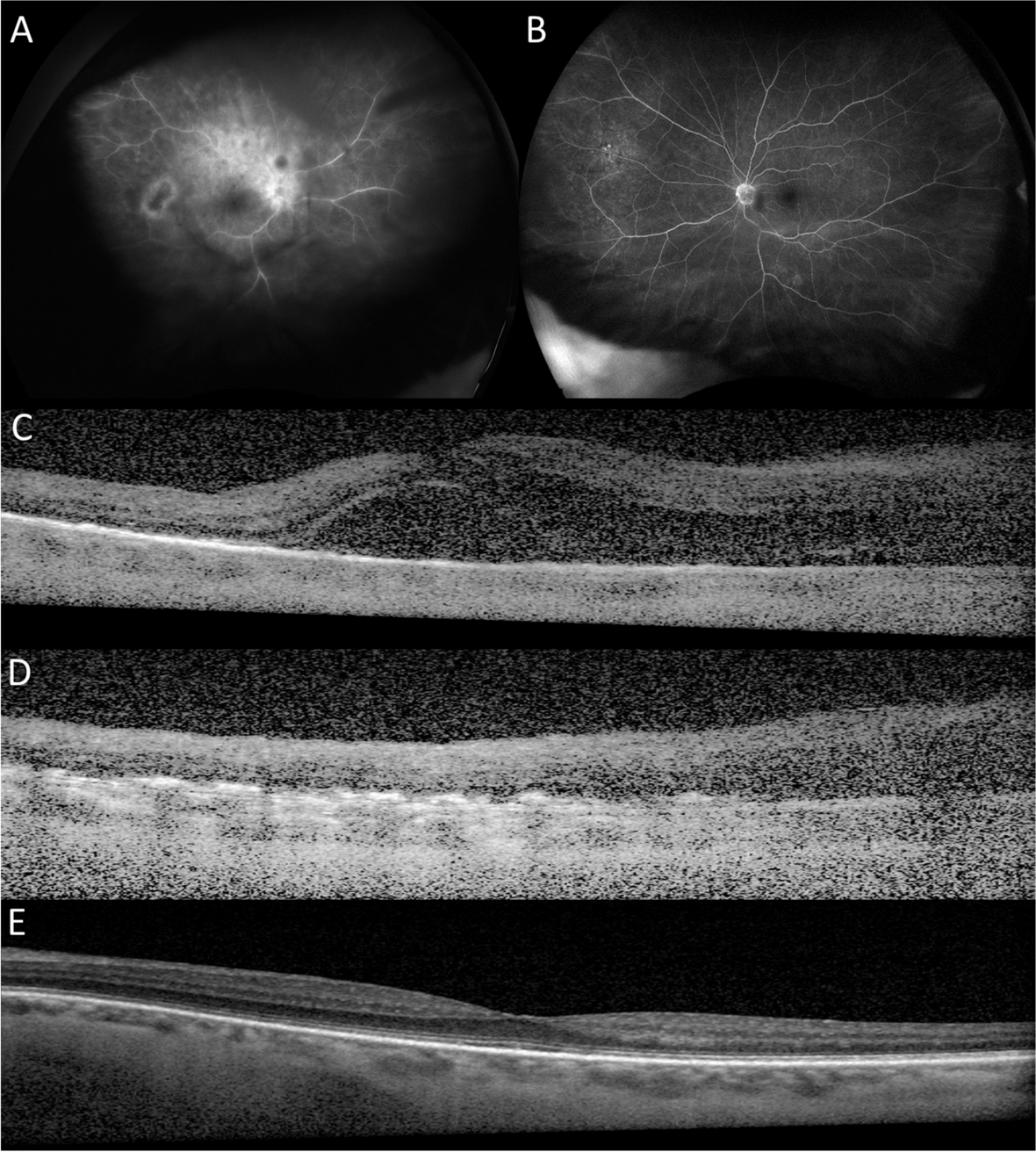 Diagnosis of primary vitreoretinal lymphoma masquerading infectious retinitis by retinal biopsy